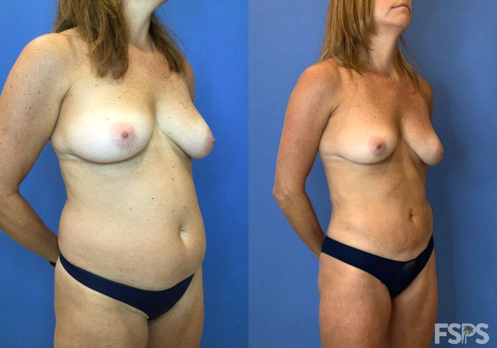 Liposuction - Thumbnail 2