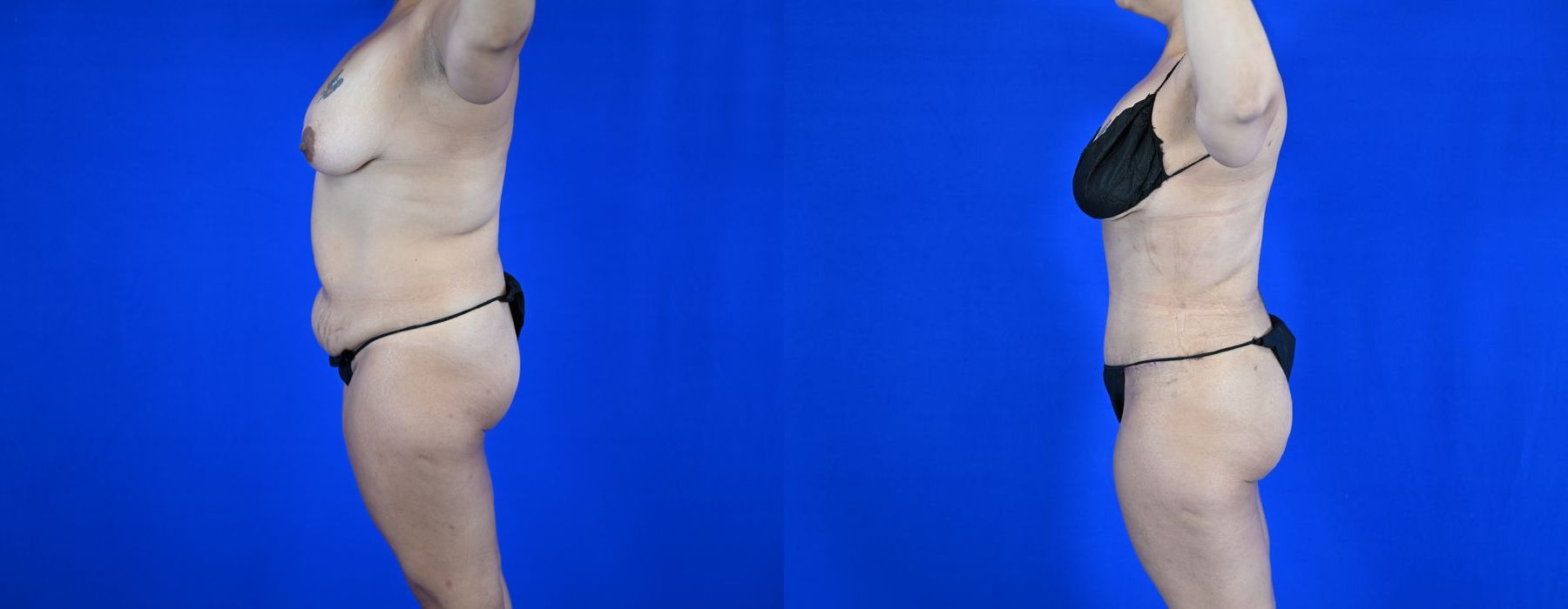 Liposuction - Thumbnail 3