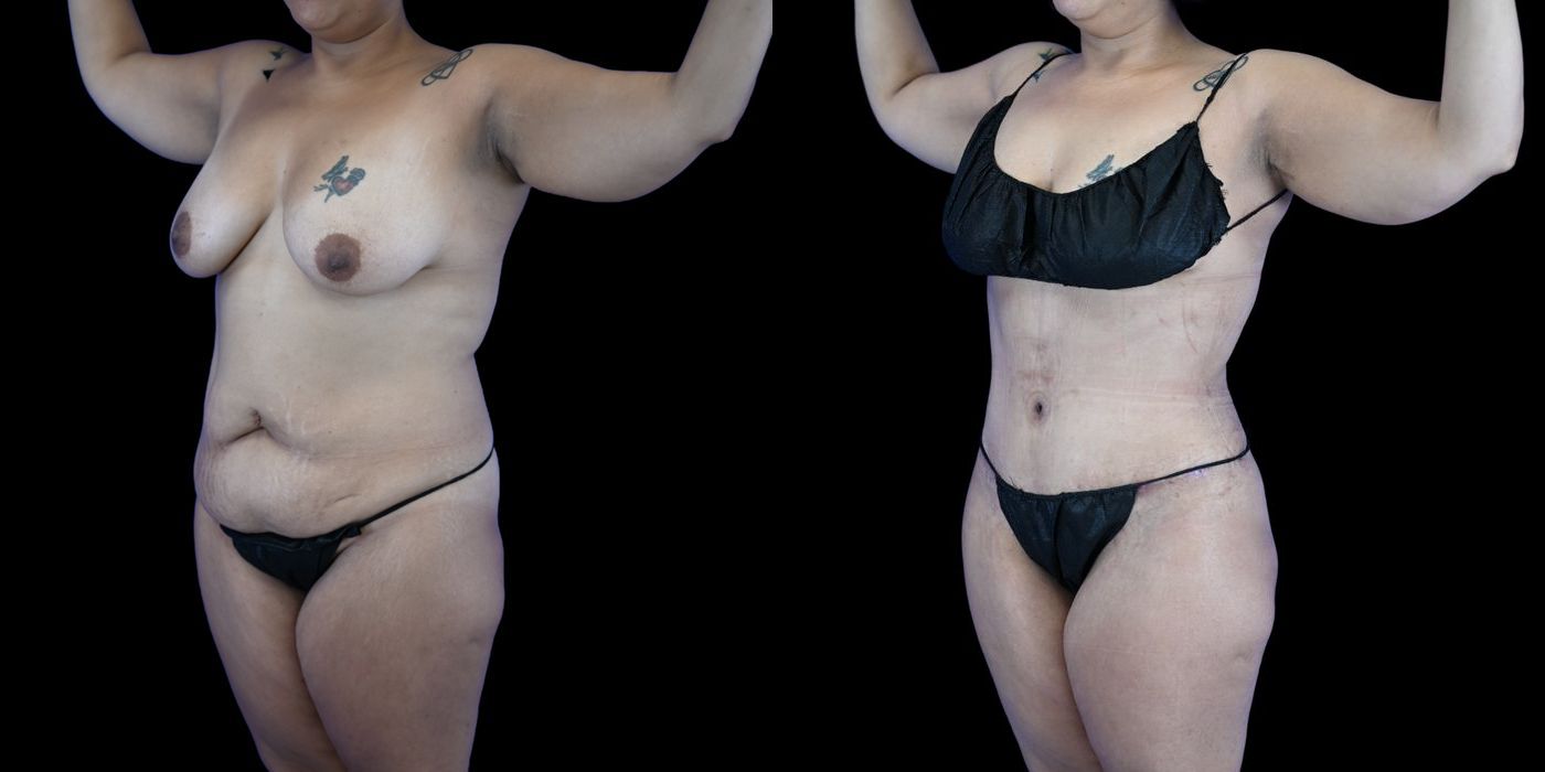 Before and after Liposuction case 26084 - Angle 2