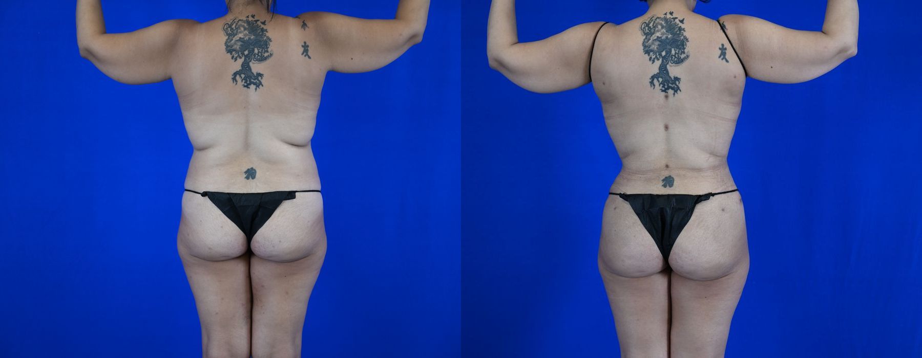 Liposuction - Thumbnail 4