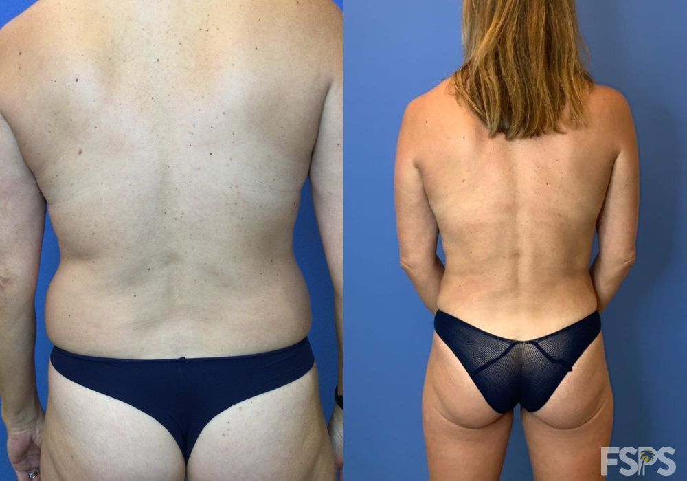 Liposuction - Thumbnail 5