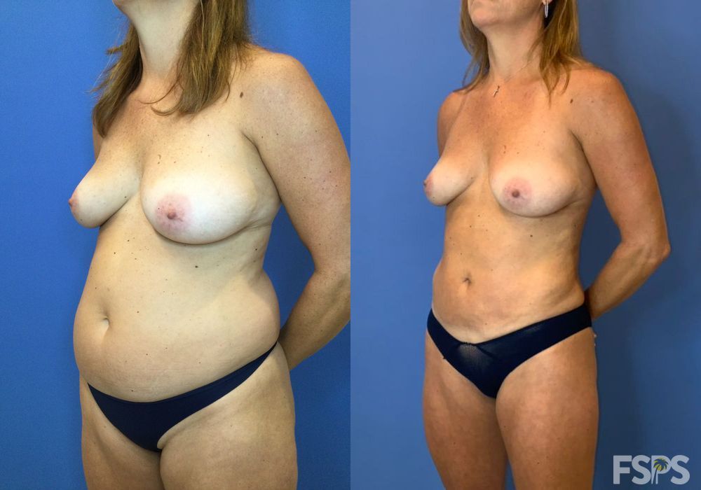 Liposuction - Thumbnail 4