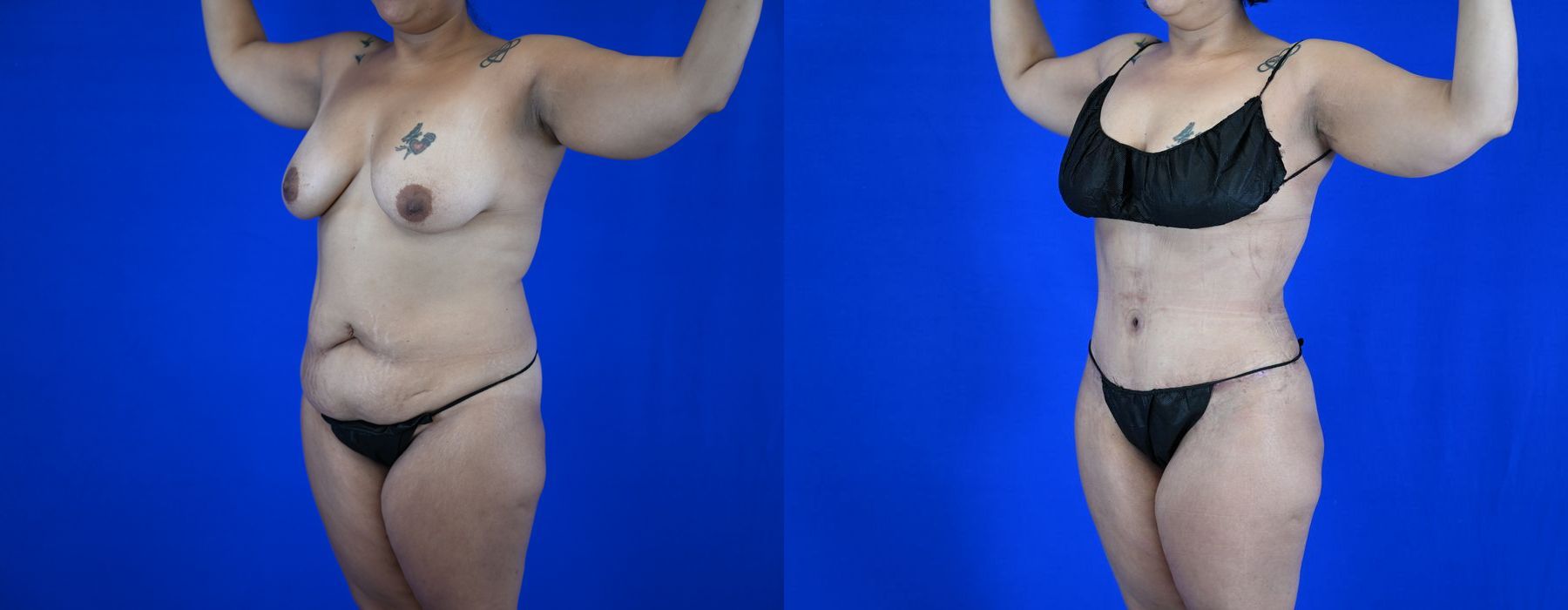 Liposuction - Thumbnail 2