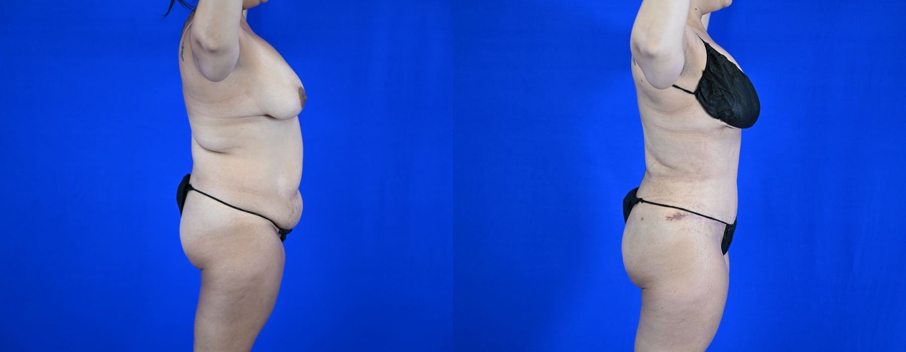 Liposuction - Thumbnail 6
