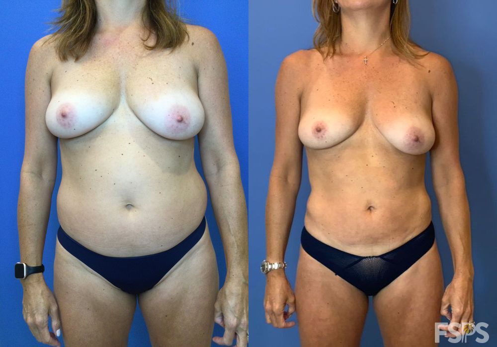 Liposuction - Case 22734
