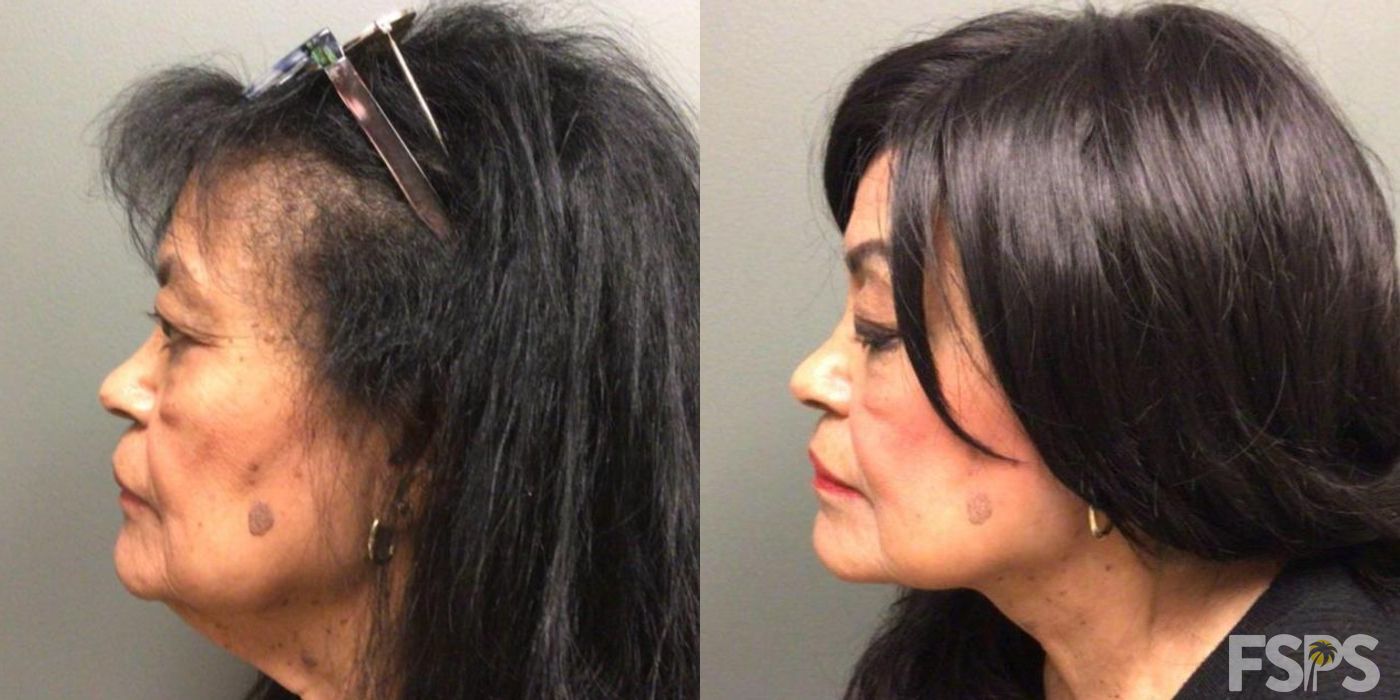 Neck Lift - Thumbnail 3