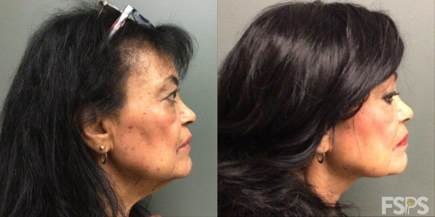 Neck Lift - Thumbnail 2