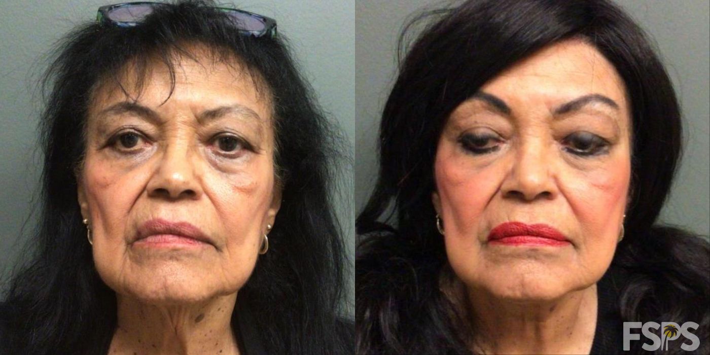 Neck Lift - Case 22829