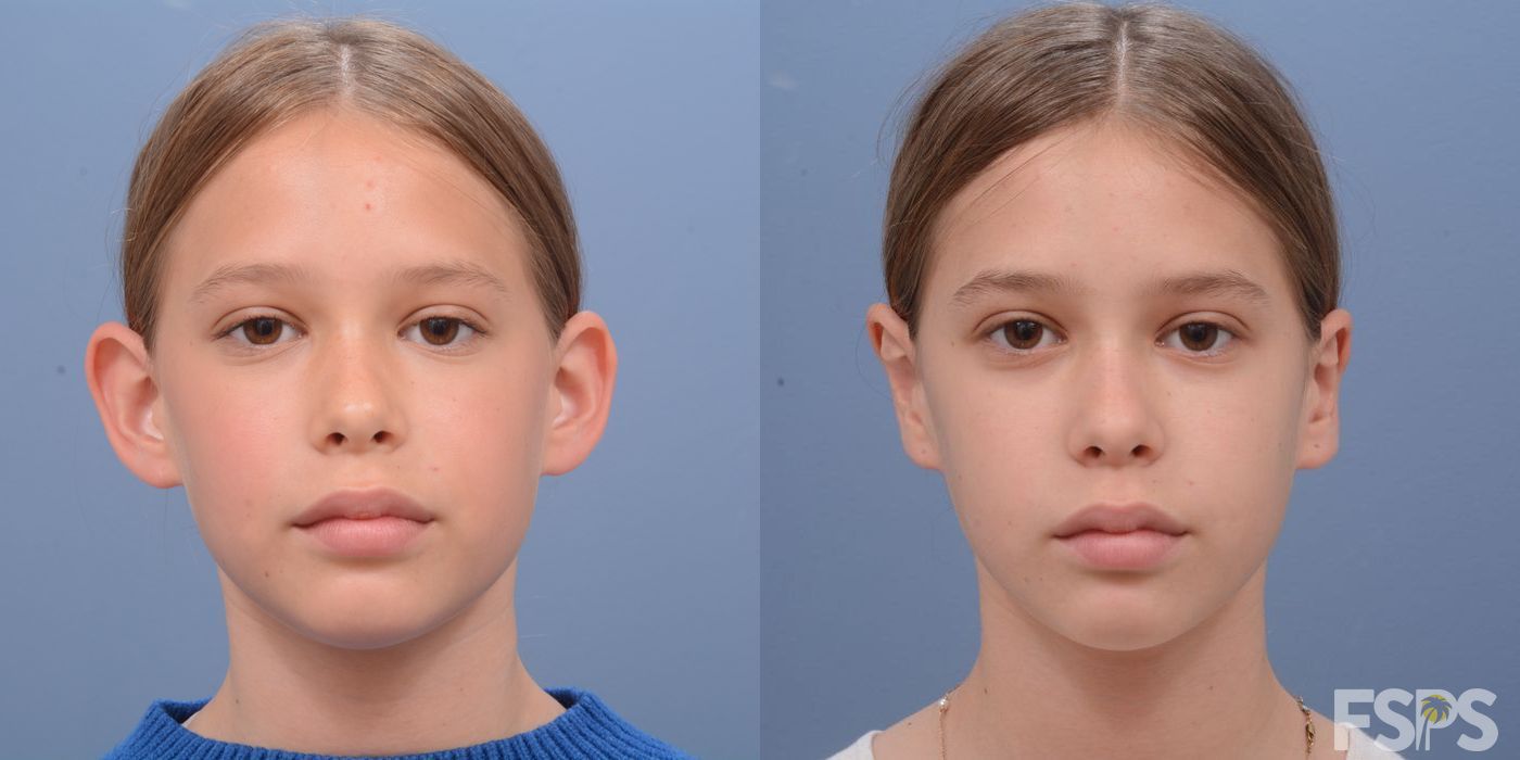 Before and after Otoplasty case 33048