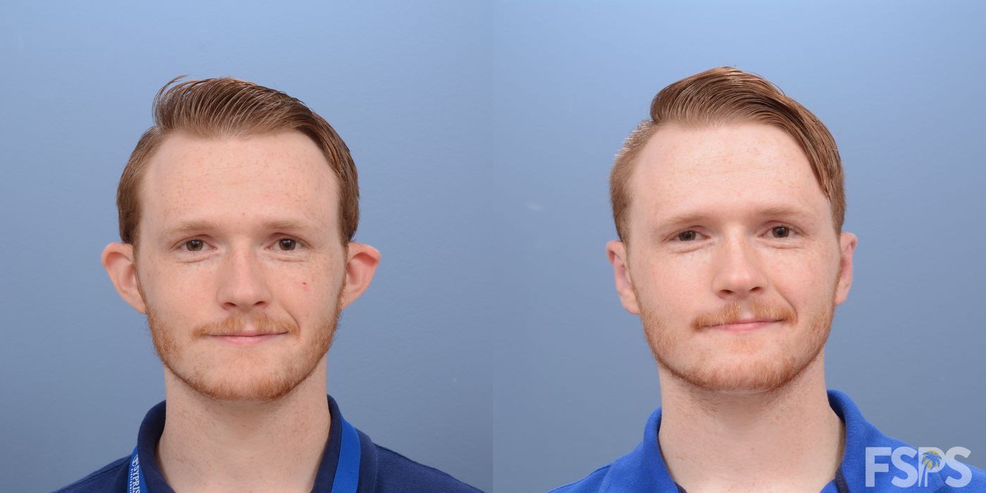 Before and after Otoplasty case 33046