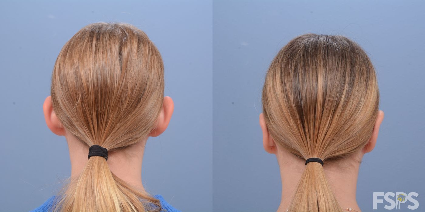 Before and after Otoplasty case 33048 - Angle 3