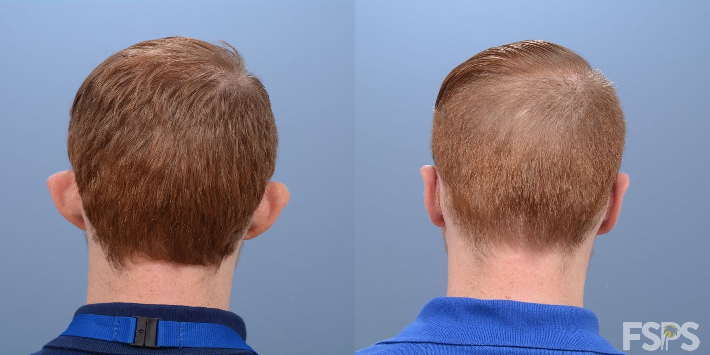 Before and after Otoplasty case 33046 - Angle 3