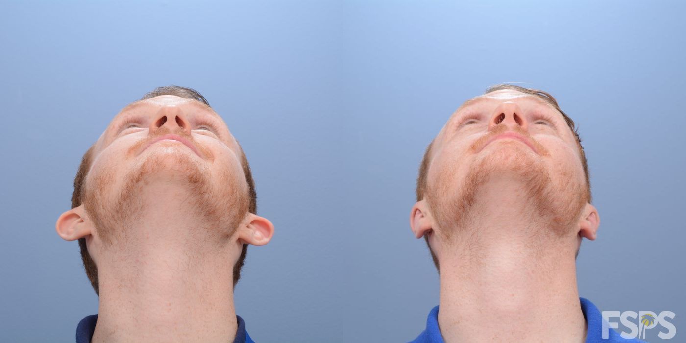 Before and after Otoplasty case 33046 - Angle 2