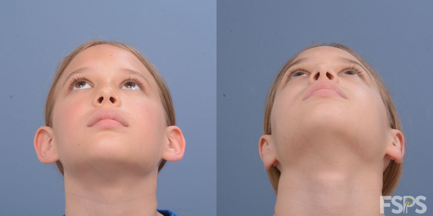 Before and after Otoplasty case 33048 - Angle 2