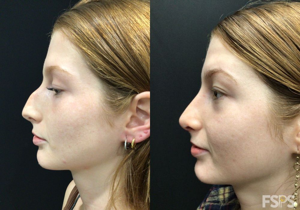 Rhinoplasty - Case 22834