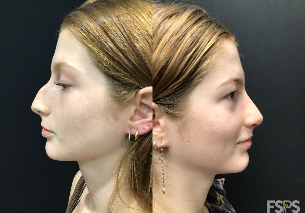 Rhinoplasty - Thumbnail 2