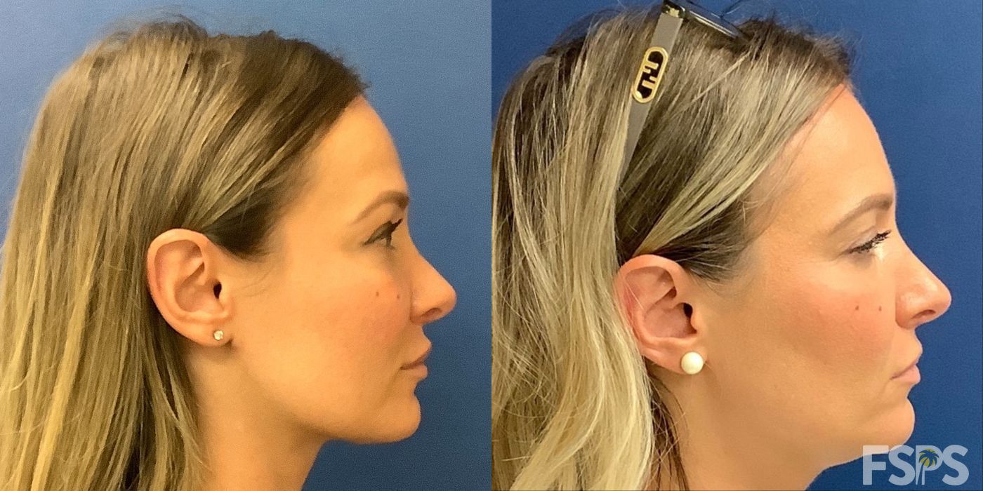 Rhinoplasty - Case 22833