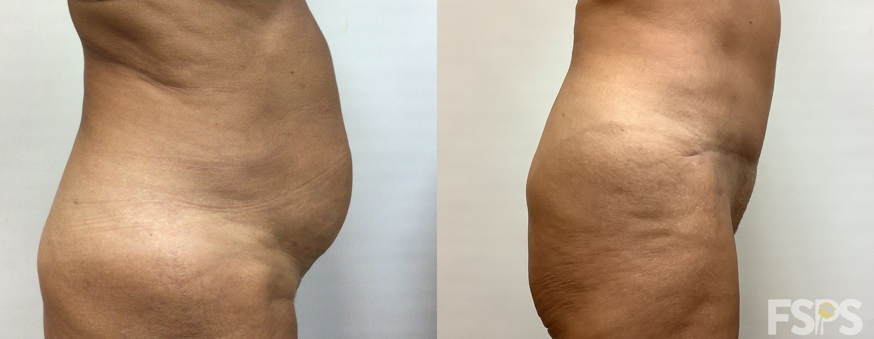 Tummy Tuck - Thumbnail 3