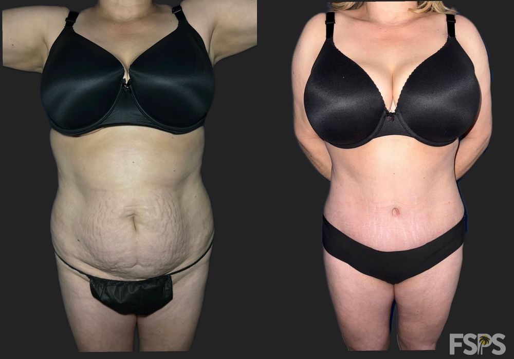 Liposuction - Case 22907