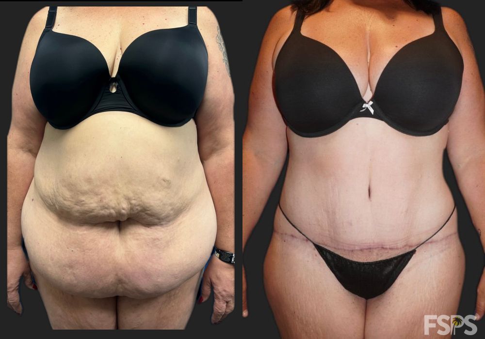 Tummy Tuck - Case 22926