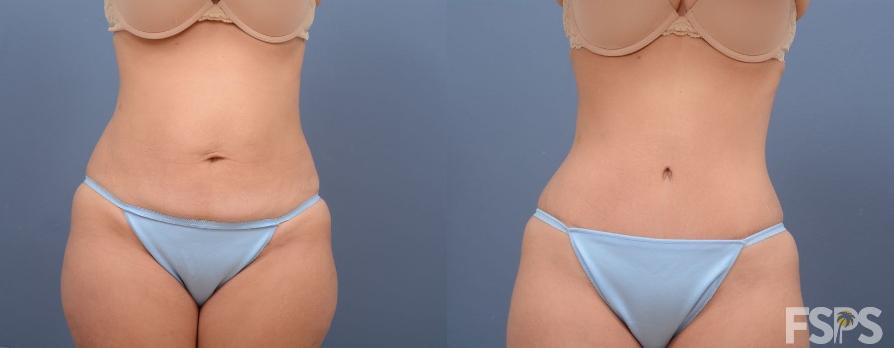 Tummy Tuck - Case 22925