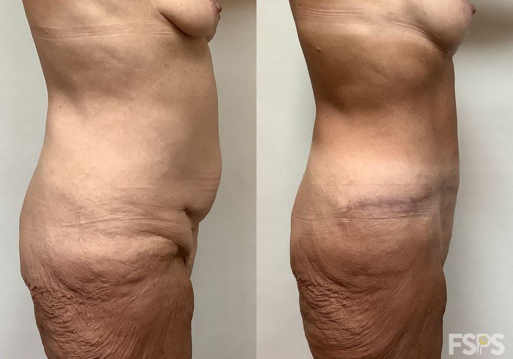 Before photo - Angle 3