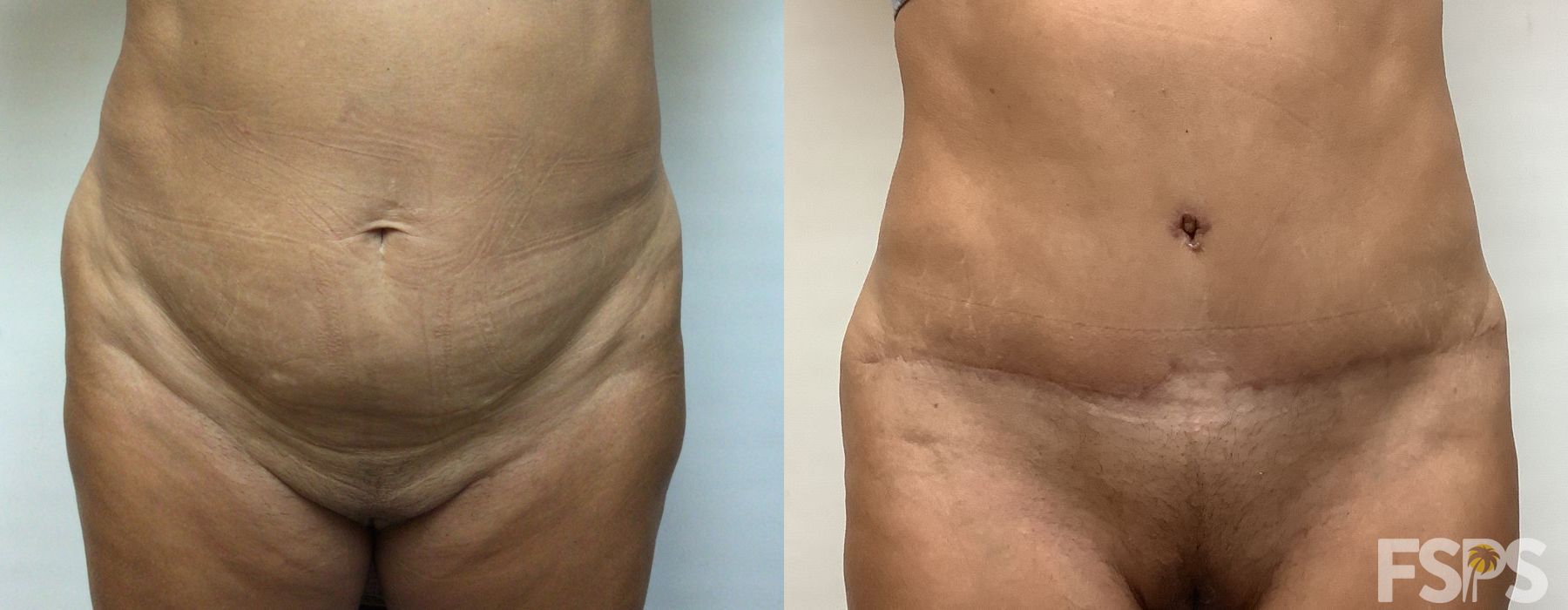 Tummy Tuck - Case 22759