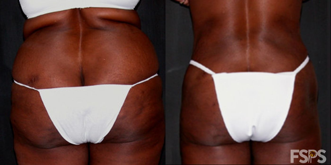 Tummy Tuck - Case 22756