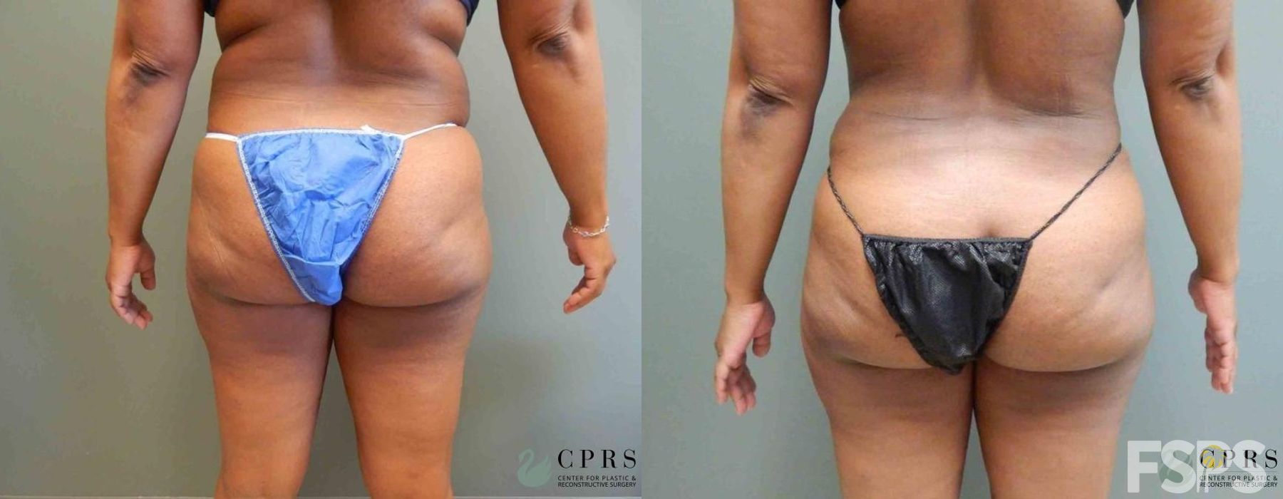 Tummy Tuck - Thumbnail 2