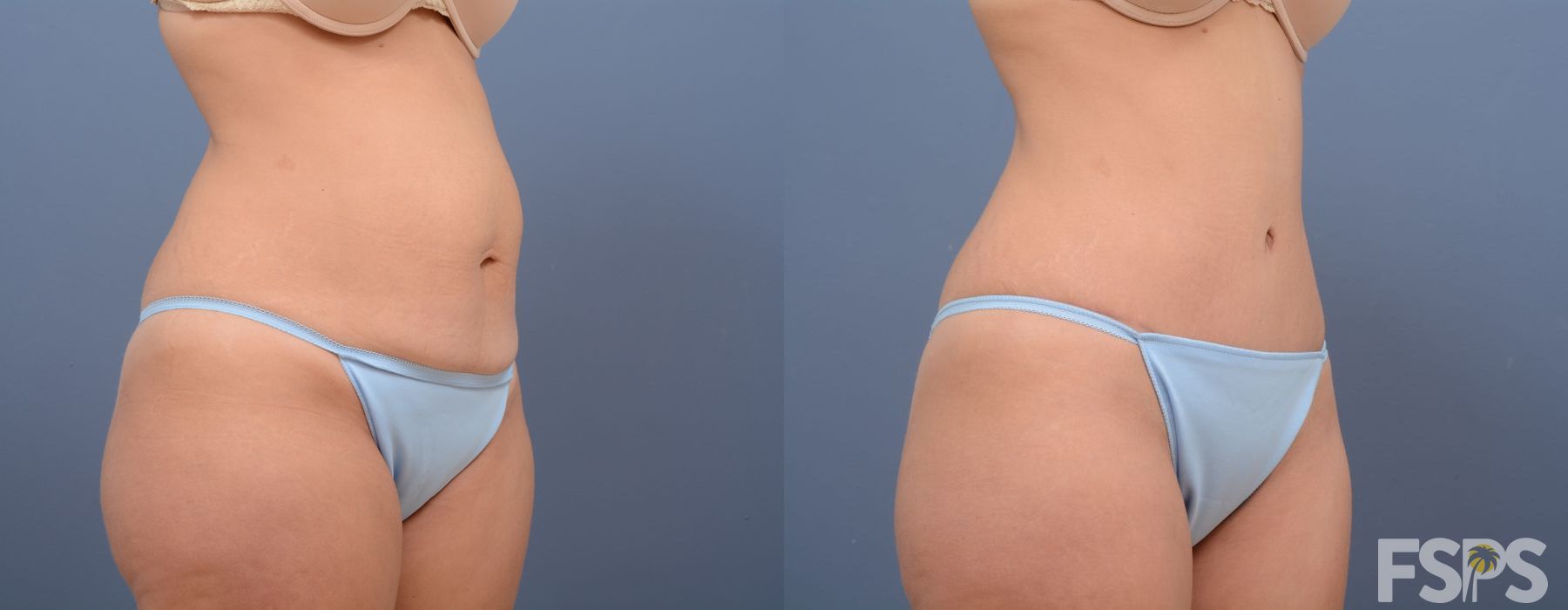 Tummy Tuck - Thumbnail 3