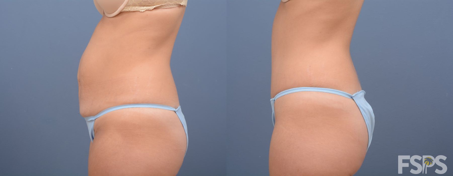 Tummy Tuck - Thumbnail 4