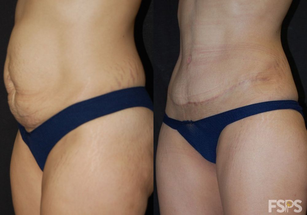 Before and after Tummy Tuck case 17627 - Angle 2