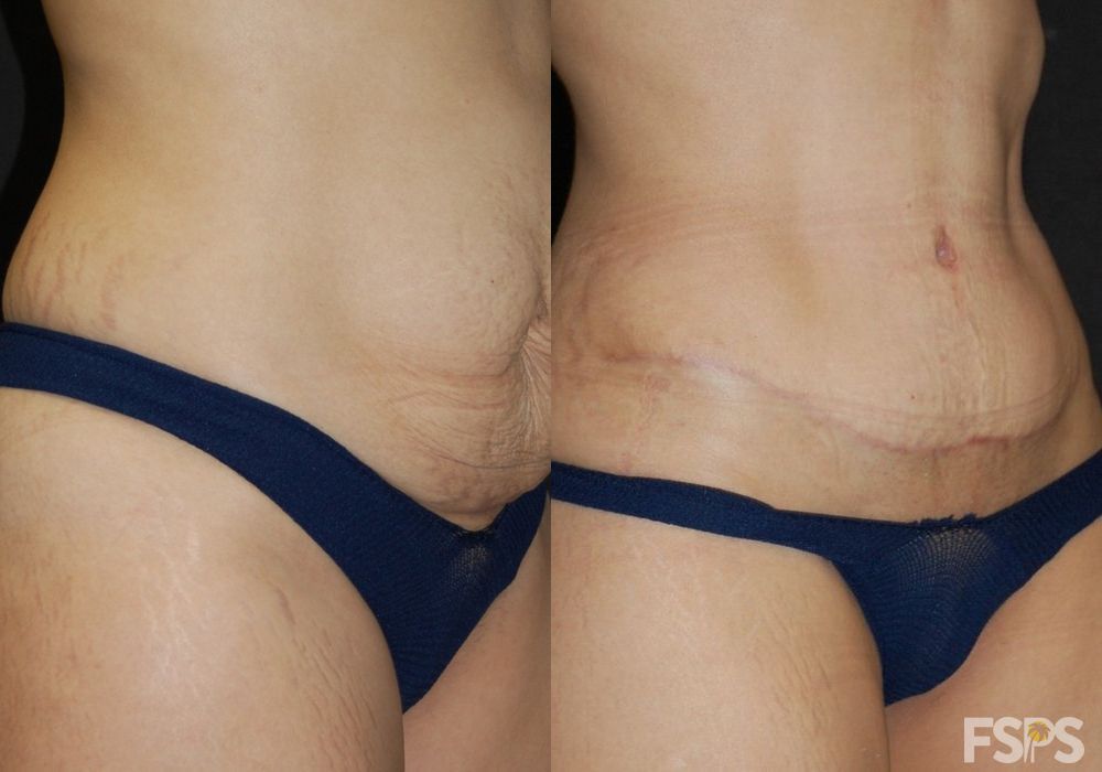 Before and after Tummy Tuck case 17627 - Angle 4