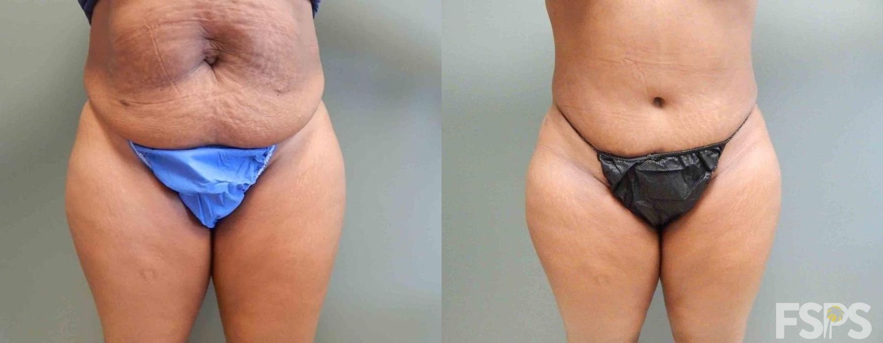 Tummy Tuck - Case 22754