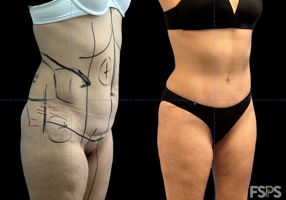 Tummy Tuck - Thumbnail 2