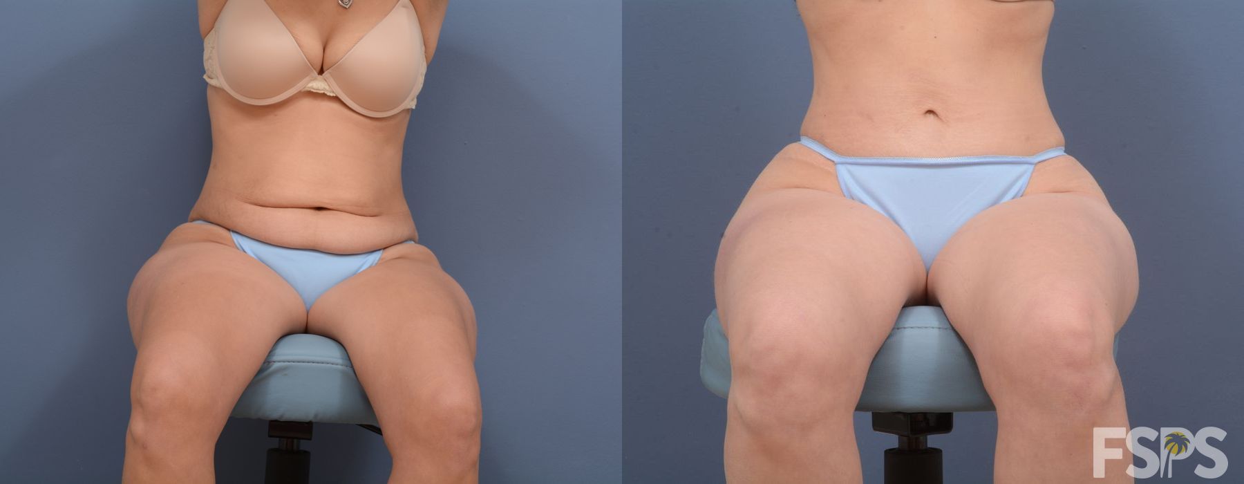 Tummy Tuck - Thumbnail 6