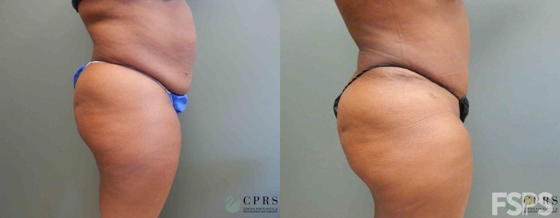 Tummy Tuck - Thumbnail 4