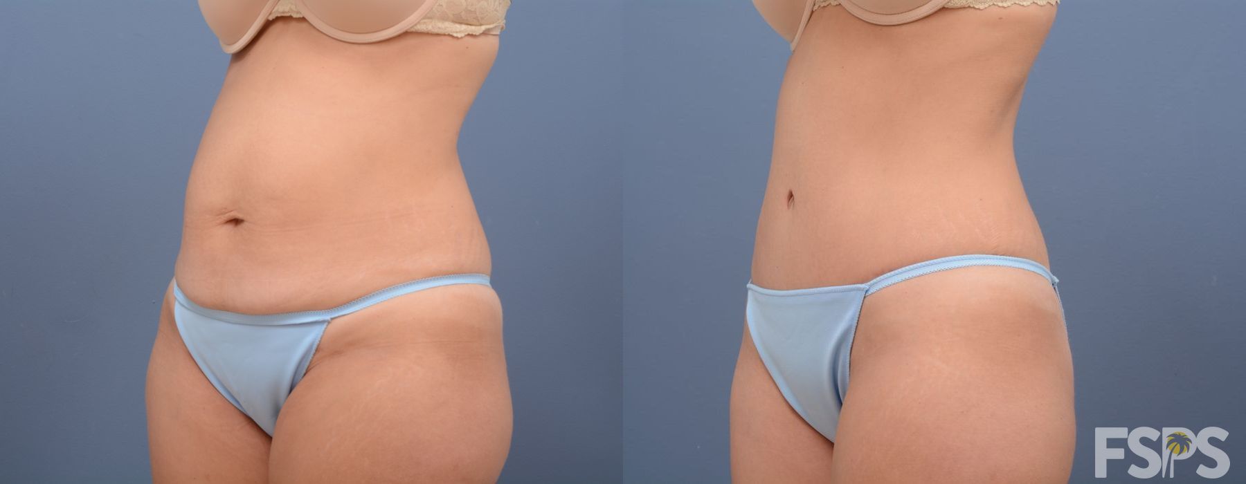 Tummy Tuck - Thumbnail 5