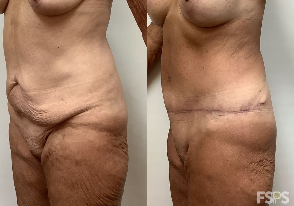 Before photo - Angle 2