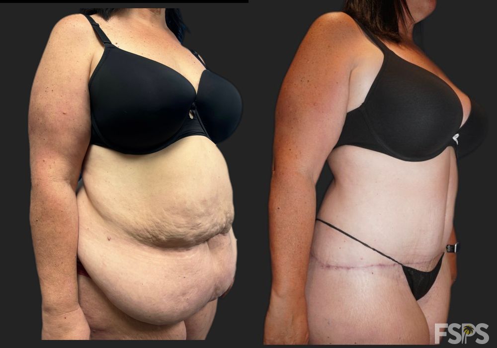 Tummy Tuck - Thumbnail 2