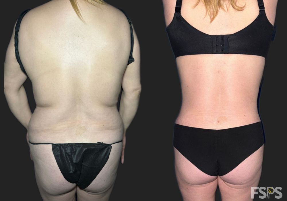 Liposuction - Thumbnail 3