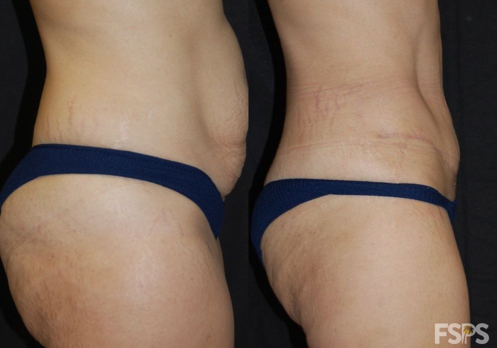 Before and after Tummy Tuck case 17627 - Angle 5