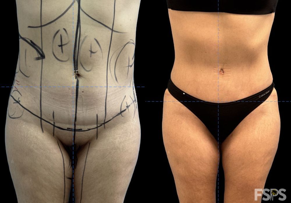 Tummy Tuck - Case 22929
