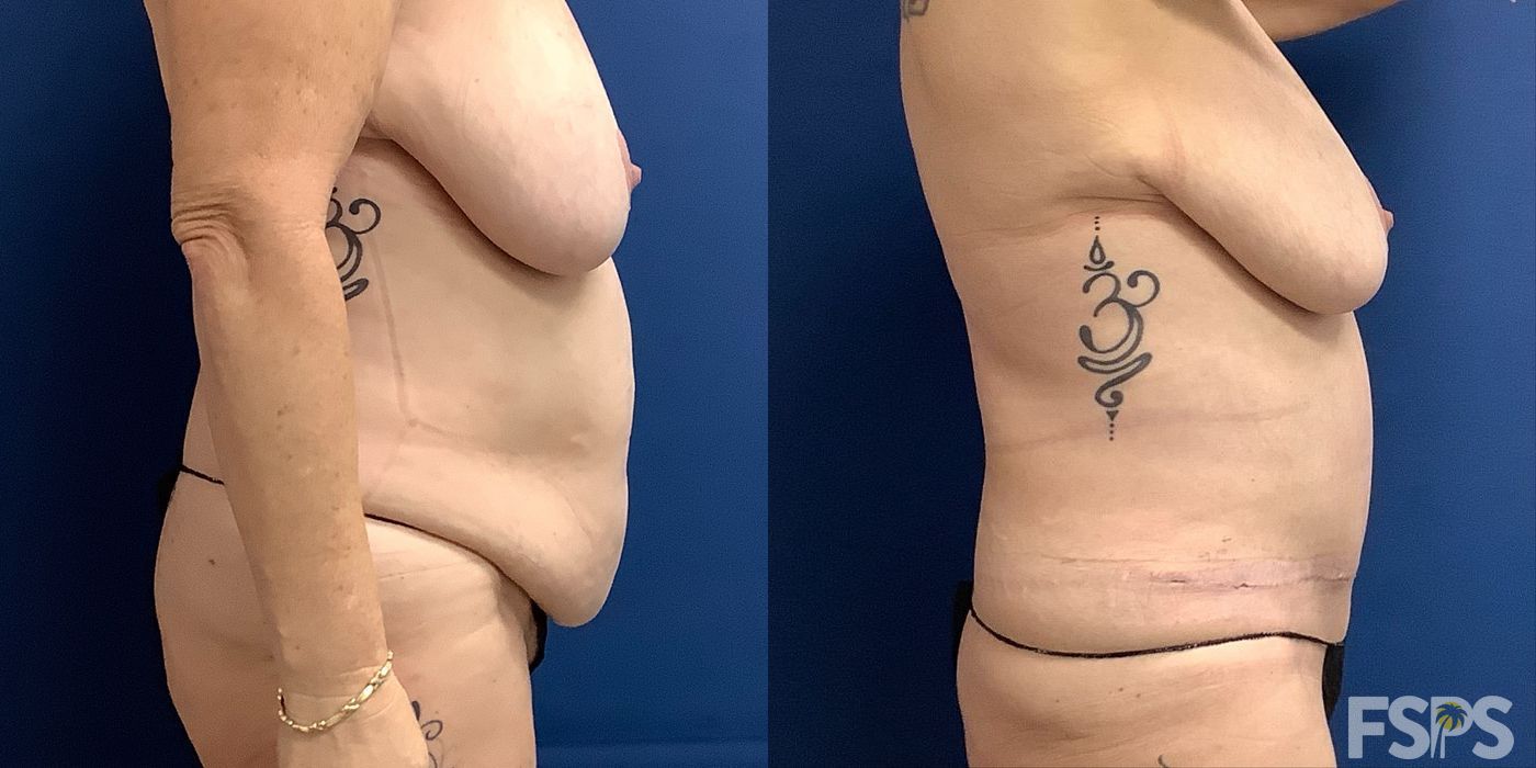 Tummy Tuck - Case 22751