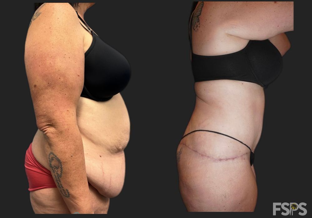 Tummy Tuck - Thumbnail 3