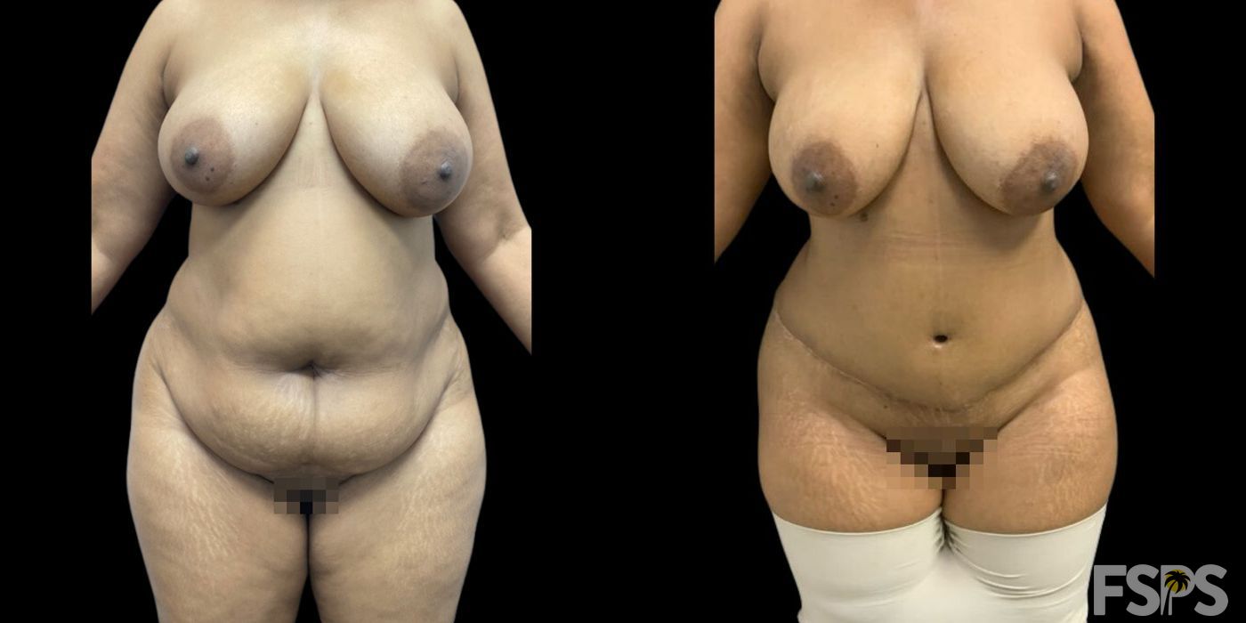Before and after Tummy Tuck case 17720 - Angle 2