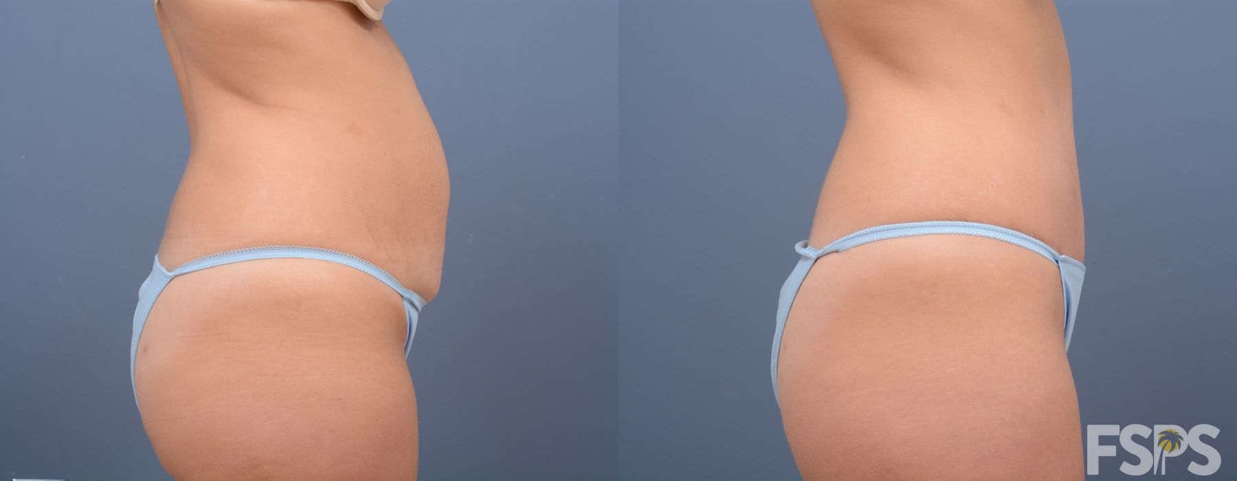 Tummy Tuck - Thumbnail 2