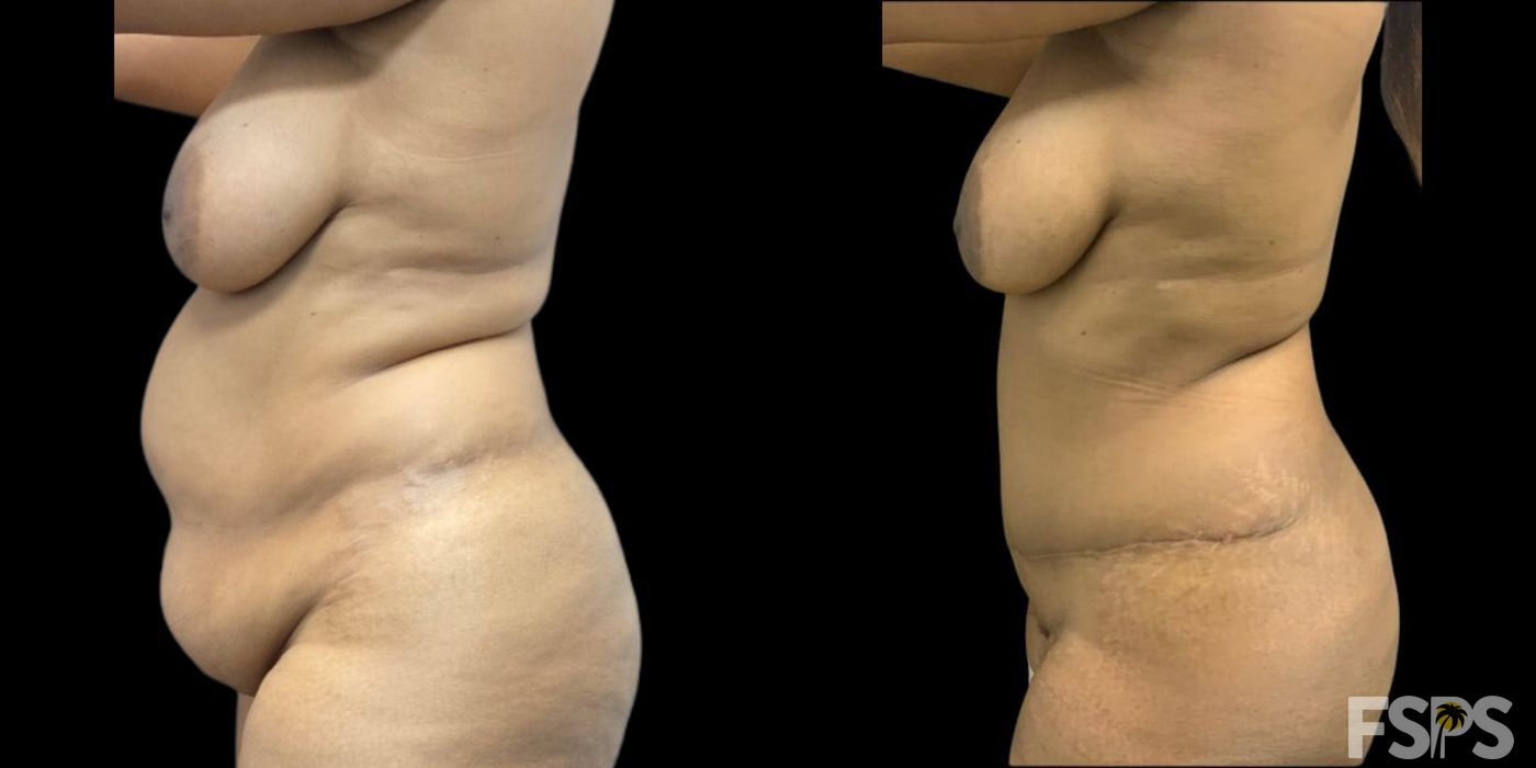 Before and after Tummy Tuck case 17720
