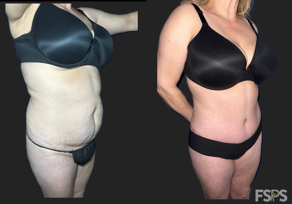 Liposuction - Thumbnail 2