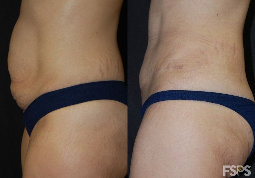 Before and after Tummy Tuck case 17627 - Angle 3